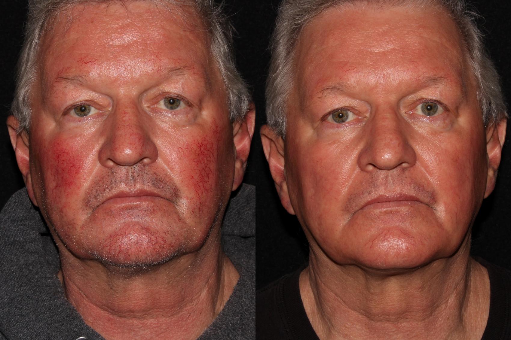 Before & After BBL™ PhotoFacial Case 9 Front View in Chico, Yuba City, & Oroville, CA