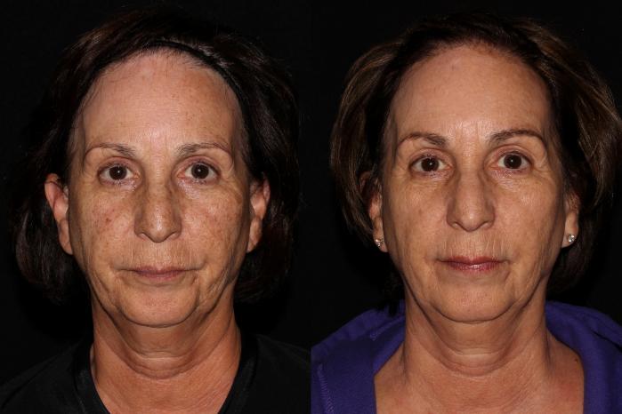 Before & After BBL™ PhotoFacial Case 36 Front View in Chico, Yuba City, & Oroville, CA