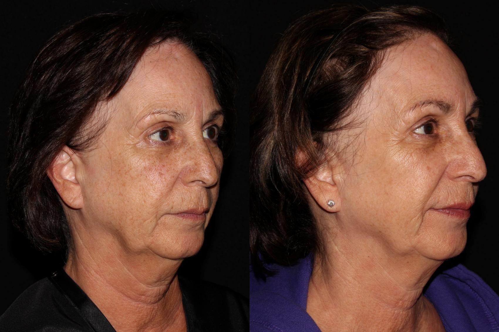 Before & After BBL™ PhotoFacial Case 36 Right Side View in Chico, Yuba City, & Oroville, CA