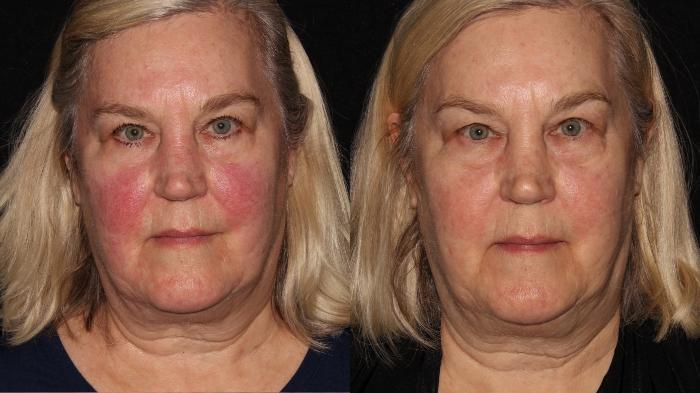 Before & After BBL™ PhotoFacial Case 5 Front View in Chico, Yuba City, & Oroville, CA