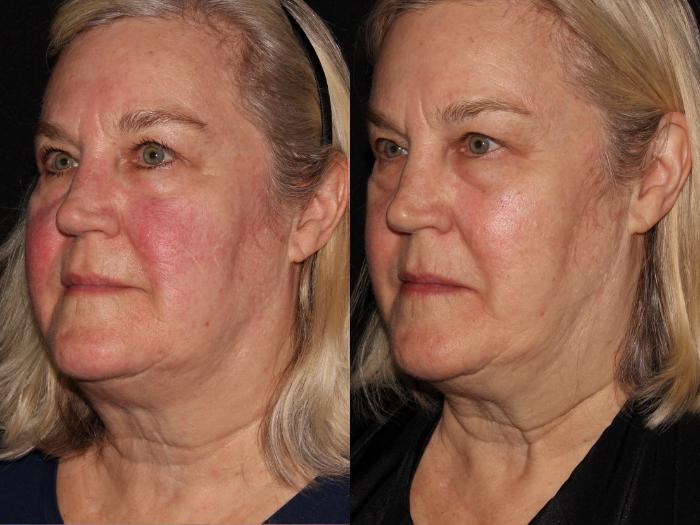 Before & After BBL™ PhotoFacial Case 5 Left Oblique View in Chico, Yuba City, & Oroville, CA