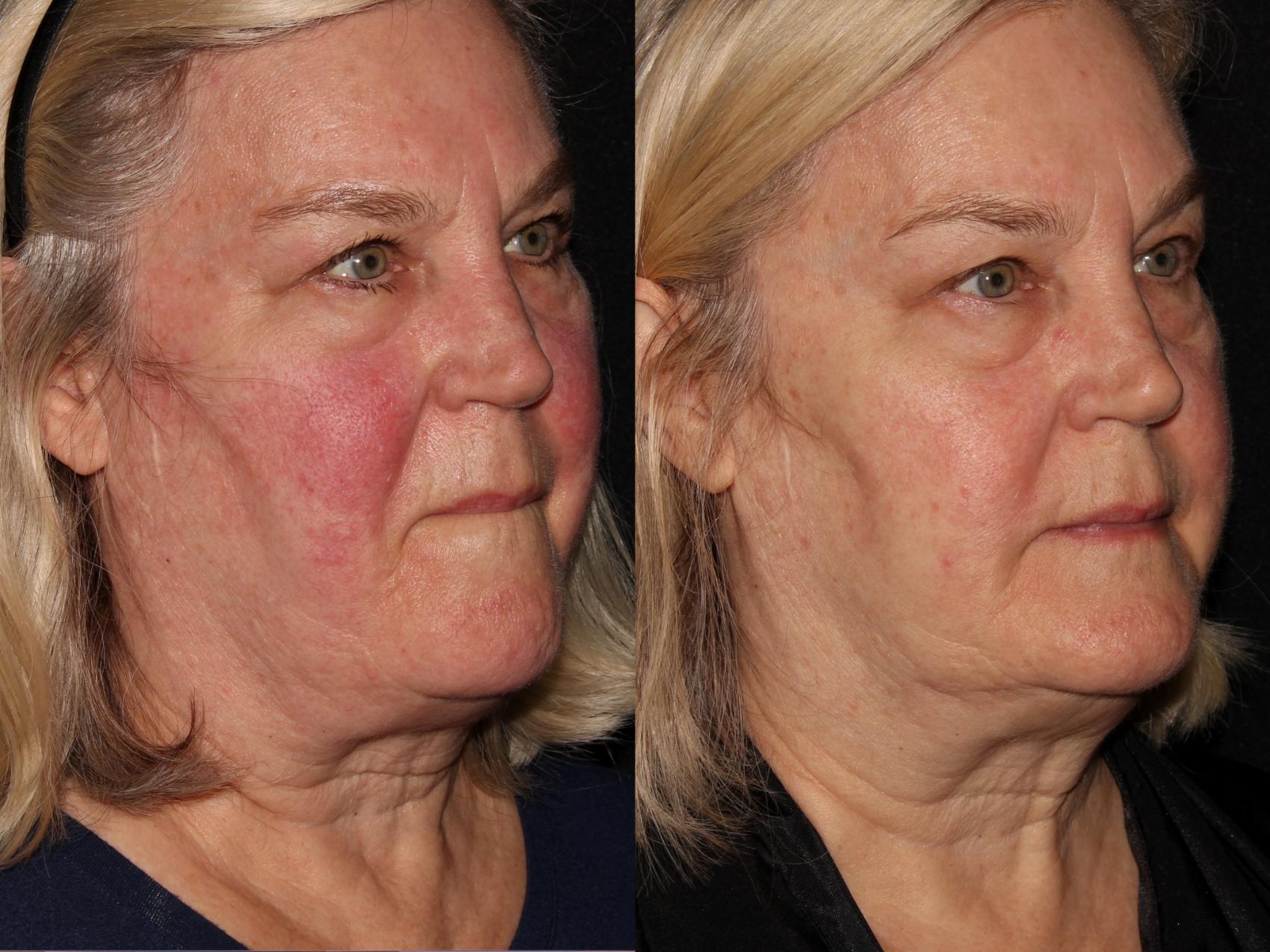 Before & After BBL™ PhotoFacial Case 5 Right Oblique View in Chico, Yuba City, & Oroville, CA