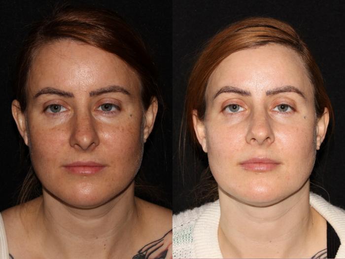 Before & After BBL™ PhotoFacial Case 6 Front View in Chico, Yuba City, & Oroville, CA