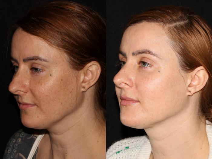 Before & After BBL™ PhotoFacial Case 6 Left Side View in Chico, Yuba City, & Oroville, CA