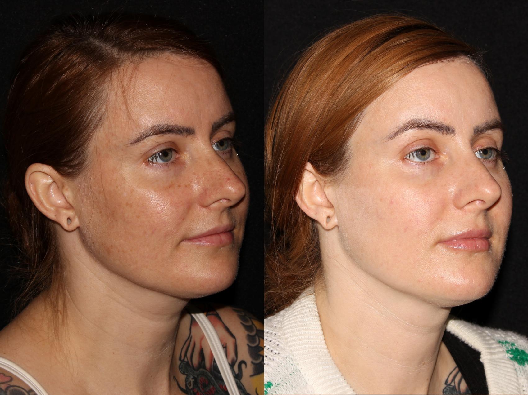 Before & After BBL™ PhotoFacial Case 6 Right Oblique View in Chico, Yuba City, & Oroville, CA