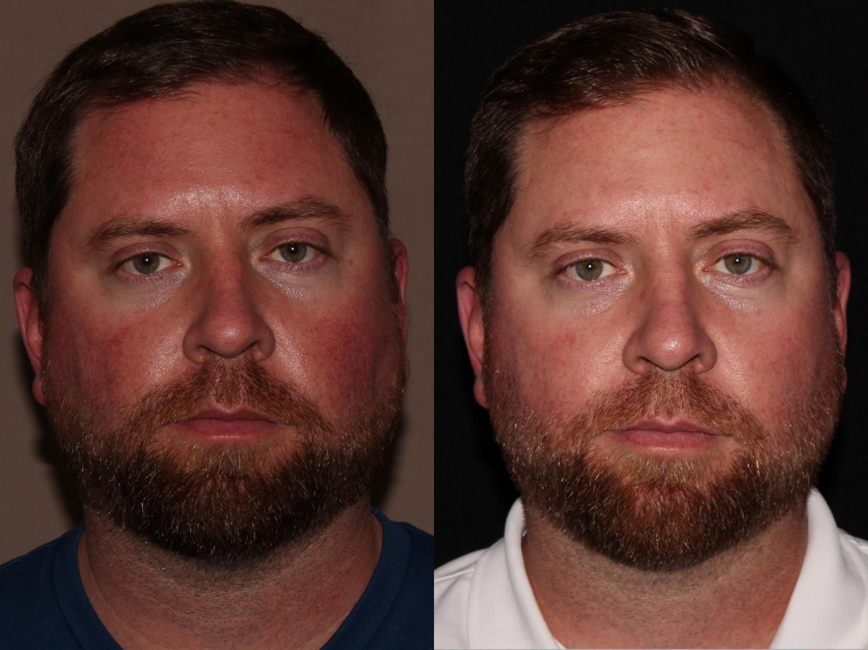Before & After BBL™ PhotoFacial Case 7 Front View in Chico, Yuba City, & Oroville, CA