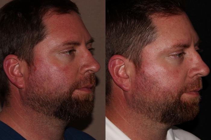 Before & After BBL™ PhotoFacial Case 7 Right Side View in Chico, Yuba City, & Oroville, CA