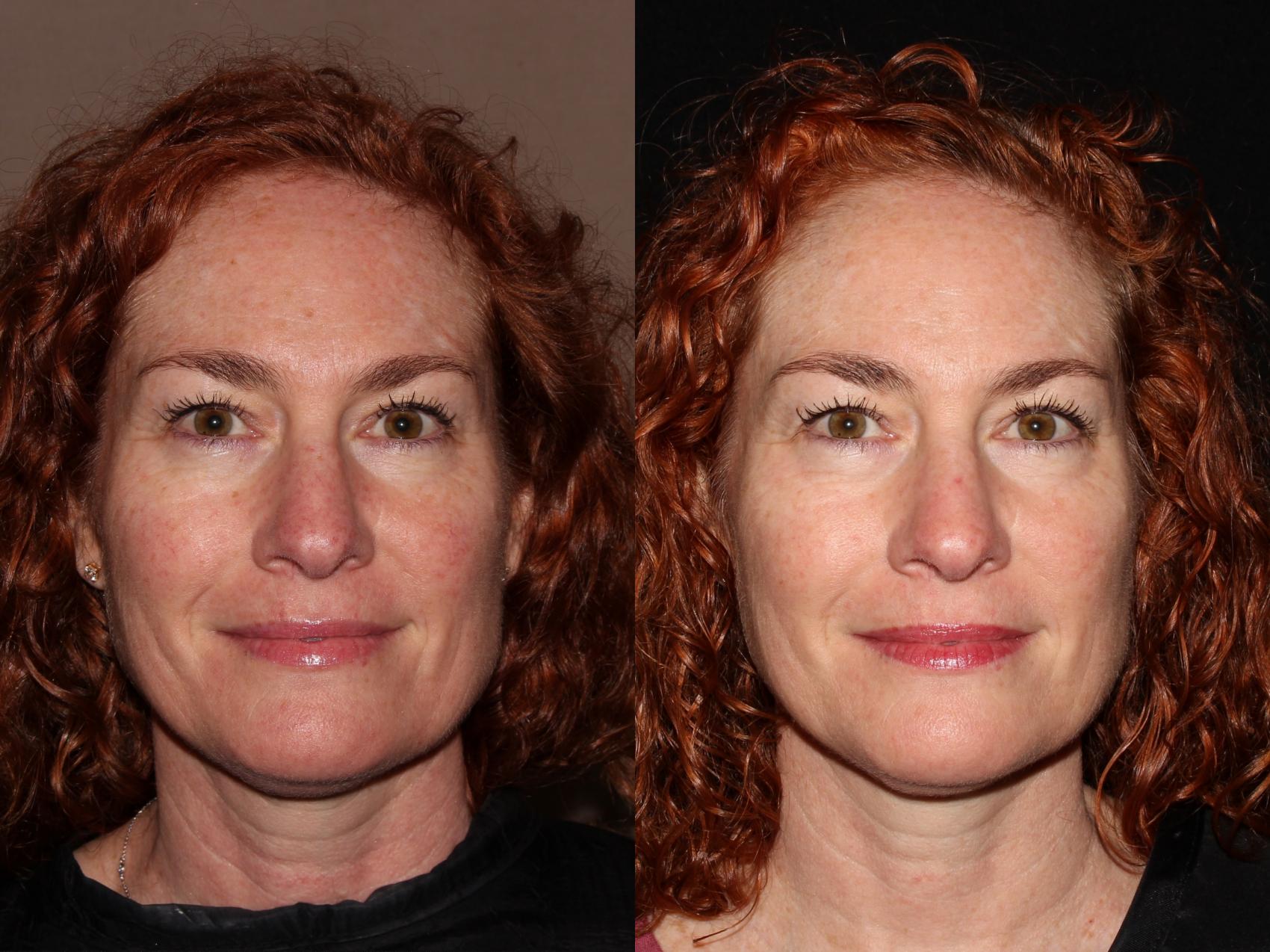 Before & After BBL™ PhotoFacial Case 8 Front View in Chico, Yuba City, & Oroville, CA