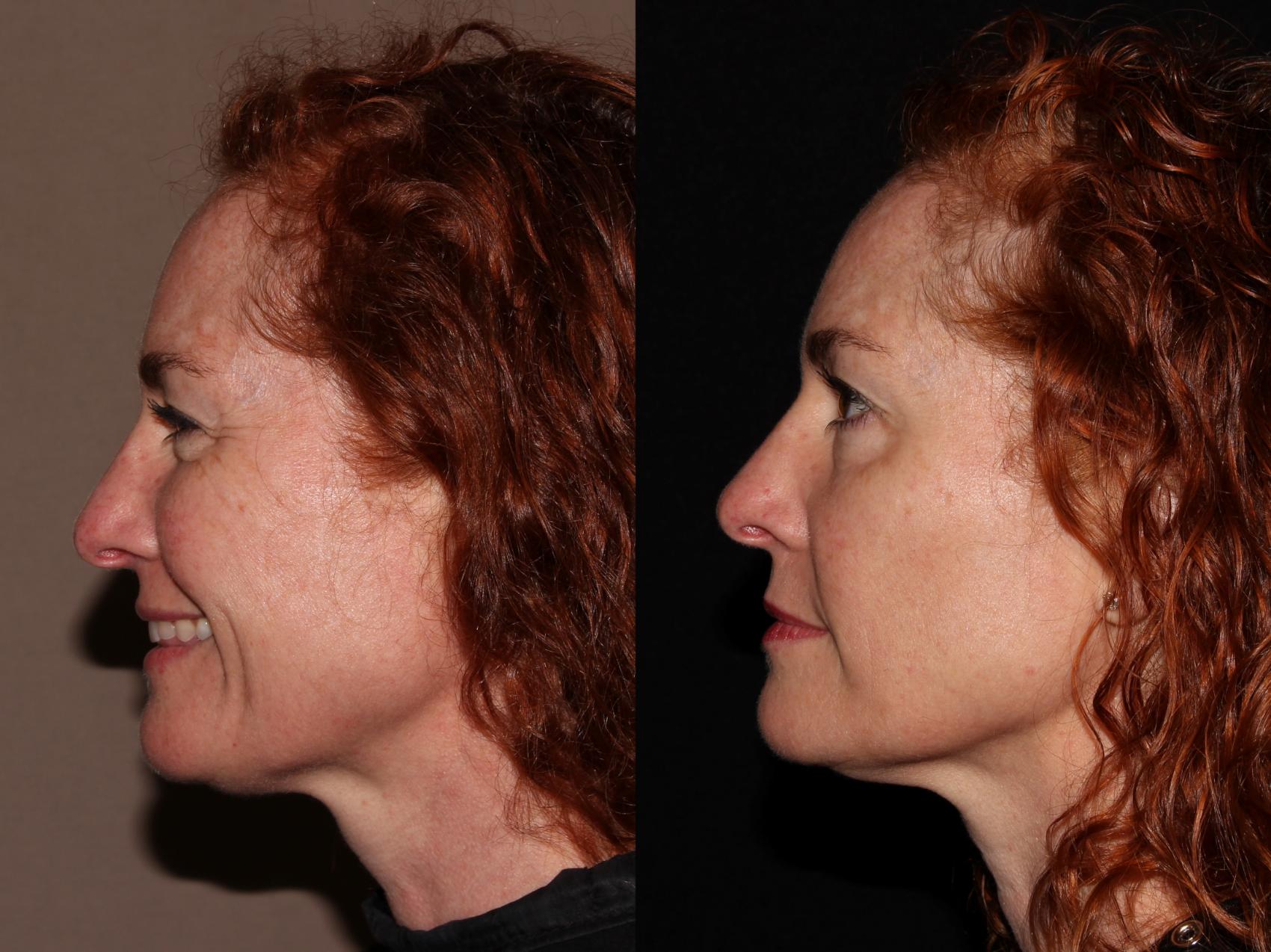 Before & After BBL™ PhotoFacial Case 8 Left Side View in Chico, Yuba City, & Oroville, CA