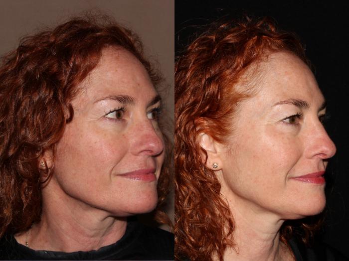 Before & After BBL™ PhotoFacial Case 8 Right Side View in Chico, Yuba City, & Oroville, CA