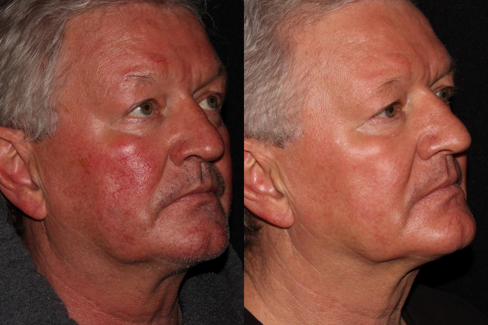 Before & After BBL™ PhotoFacial Case 9 Right Oblique View in Chico, Yuba City, & Oroville, CA