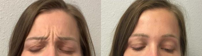 Before & After BOTOX® Cosmetic Case 33 Front View in Chico, Yuba City, & Oroville, CA