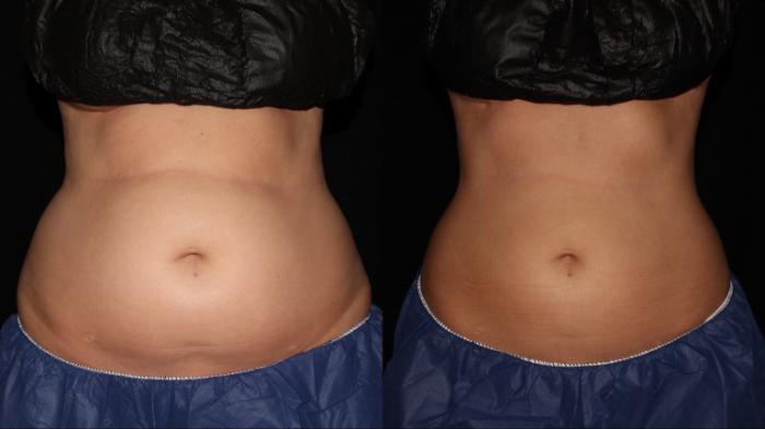 Before & After CoolSculpting® Case 10 Front View in Chico, Yuba City, & Oroville, CA