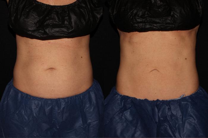 Before & After CoolSculpting® Case 11 Front View in Chico, Yuba City, & Oroville, CA