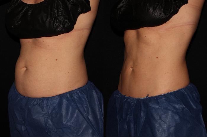 Before & After CoolSculpting® Case 11 Left Oblique View in Chico, Yuba City, & Oroville, CA