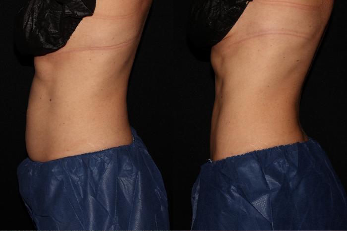Before & After CoolSculpting® Case 11 Left Side View in Chico, Yuba City, & Oroville, CA