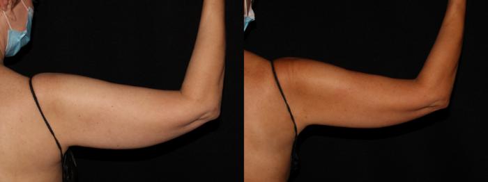 Before & After CoolSculpting® Case 12 Back View in Chico, Yuba City, & Oroville, CA