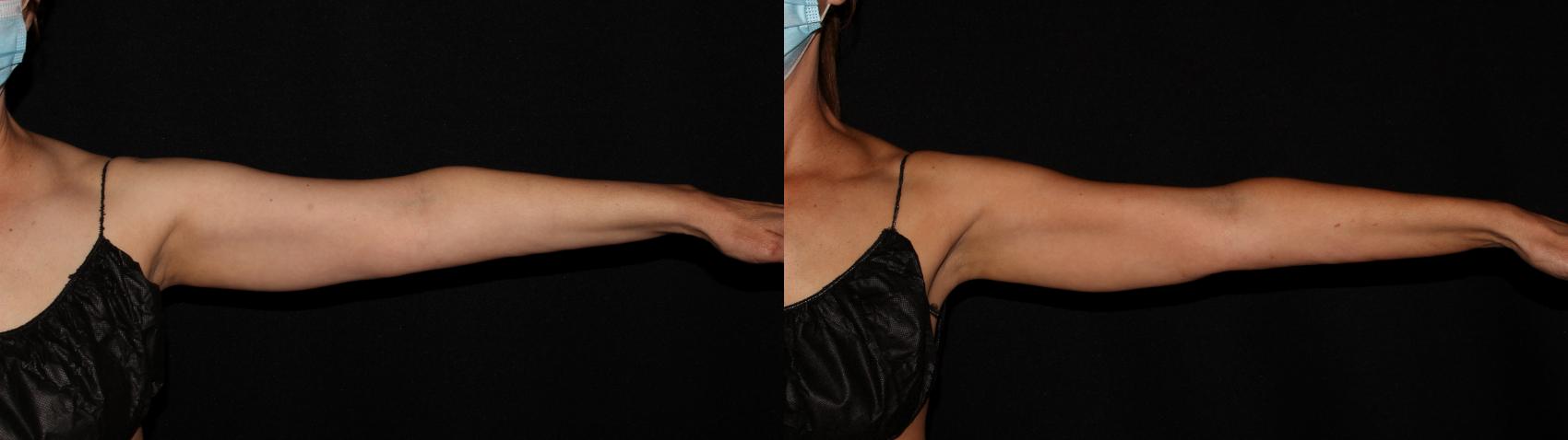 Before & After CoolSculpting® Case 12 Front View in Chico, Yuba City, & Oroville, CA