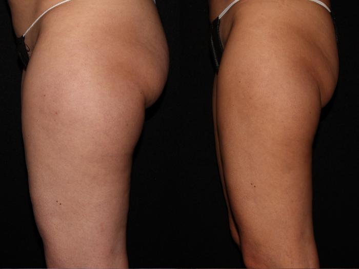 Before & After CoolSculpting® Case 12 Left Side View in Chico, Yuba City, & Oroville, CA