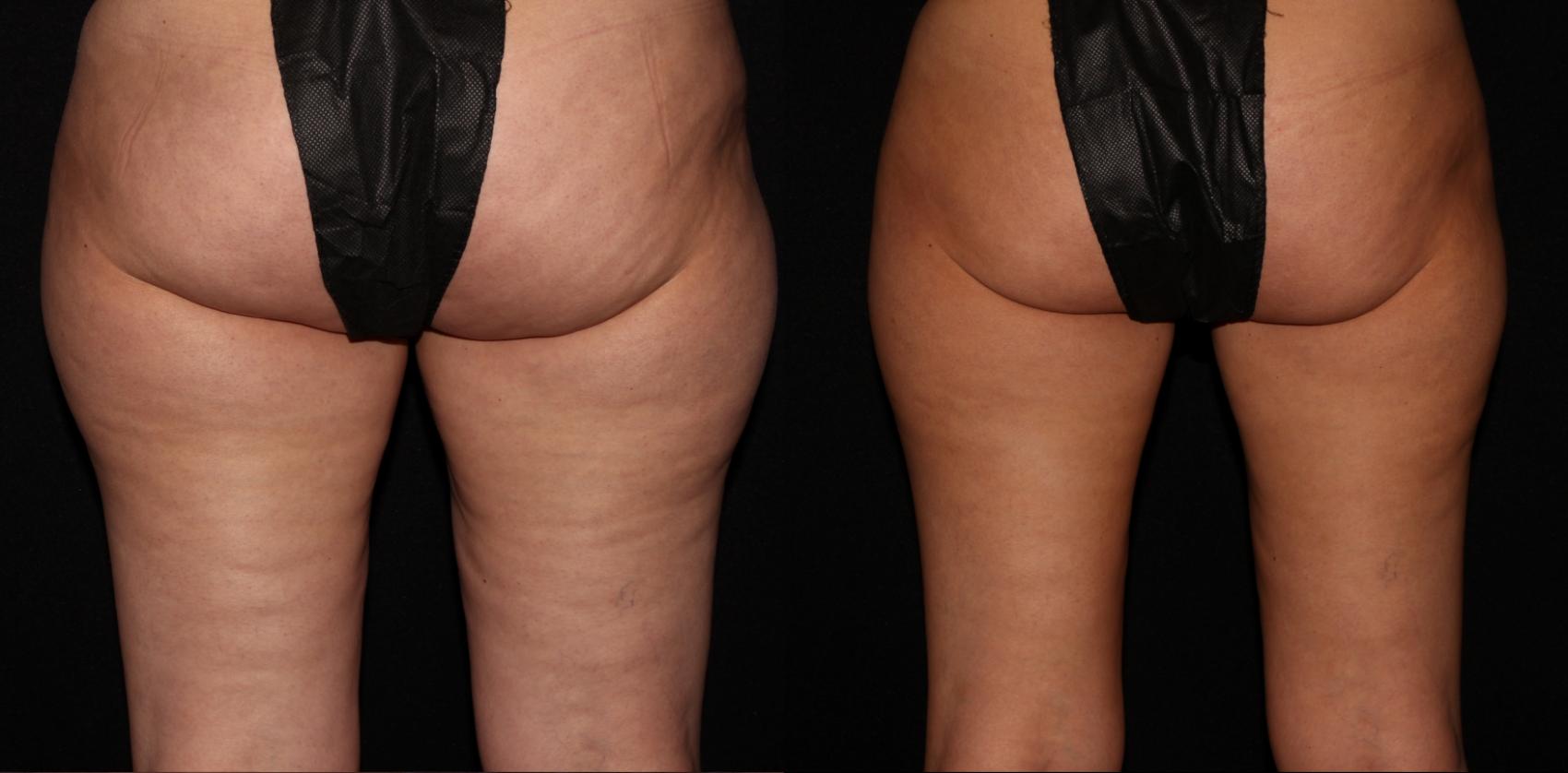Before & After CoolSculpting® Case 12 Posterior View in Chico, Yuba City, & Oroville, CA