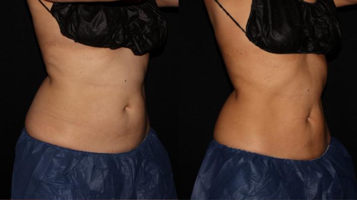 Before & After CoolSculpting® Case 12 Right Oblique View in Chico, Yuba City, & Oroville, CA
