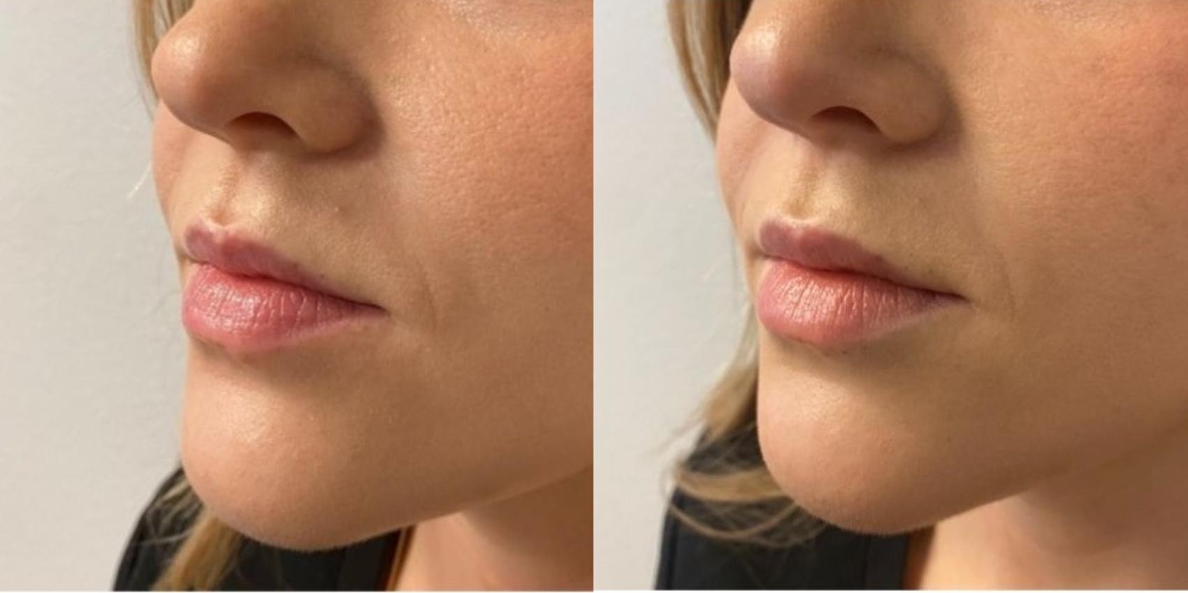 Before & After Dermal Fillers Case 15 Left Oblique View in Chico, Yuba City, & Oroville, CA