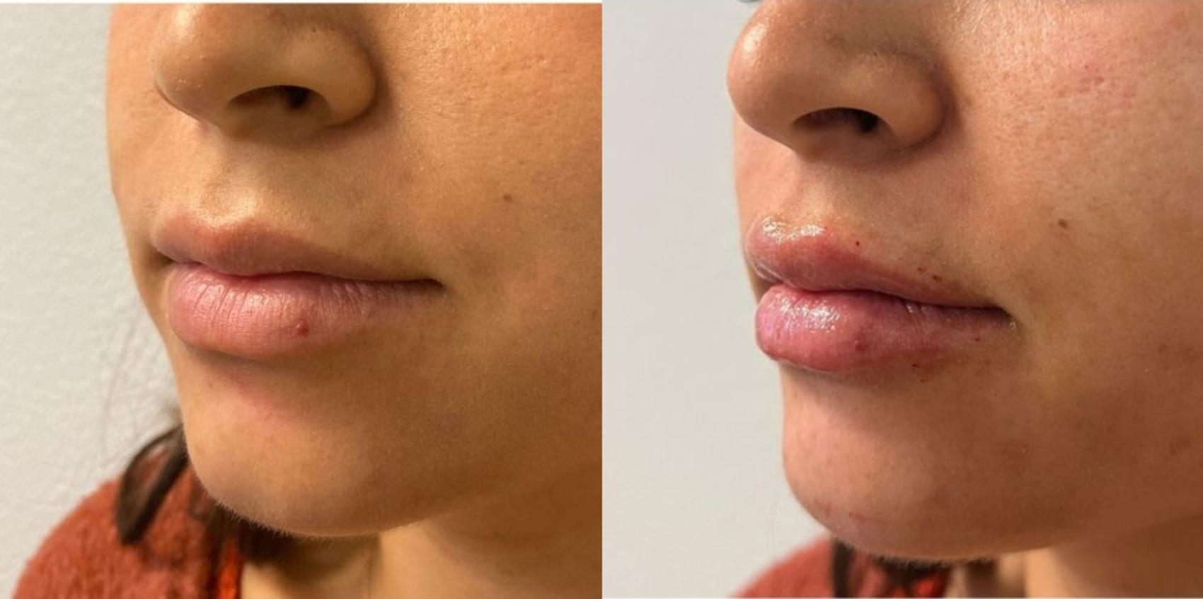Before & After Dermal Fillers Case 16 Left Oblique View in Chico, Yuba City, & Oroville, CA
