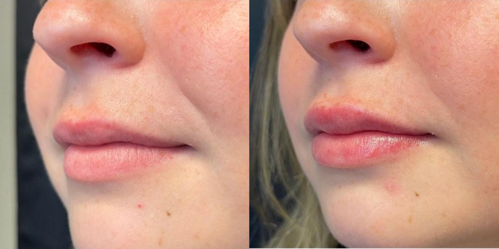 Before & After Dermal Fillers Case 17 Left Oblique View in Chico, Yuba City, & Oroville, CA