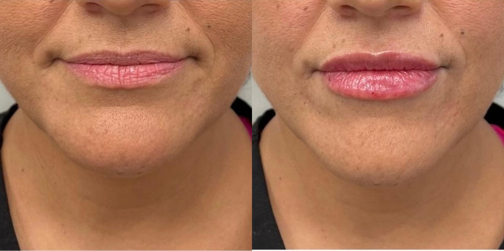 Before & After Dermal Fillers Case 19 Front View in Chico, Yuba City, & Oroville, CA