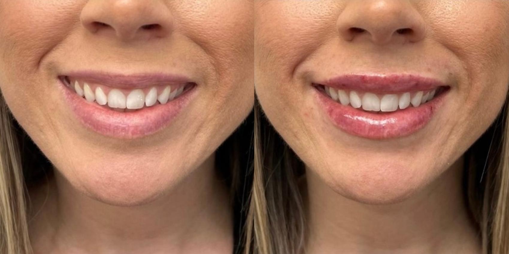 Before & After Dermal Fillers Case 20 Front View in Chico, Yuba City, & Oroville, CA