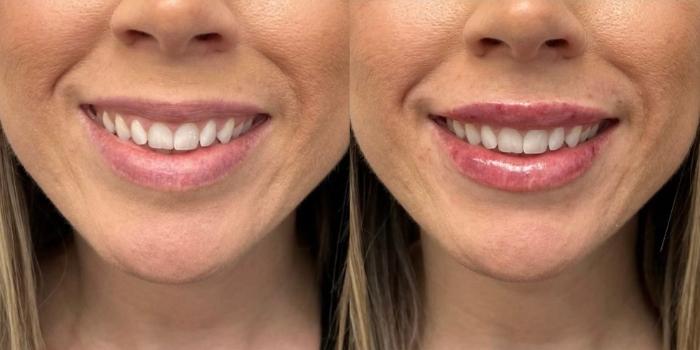 Before & After Dermal Fillers Case 20 Front View in Chico, Yuba City, & Oroville, CA