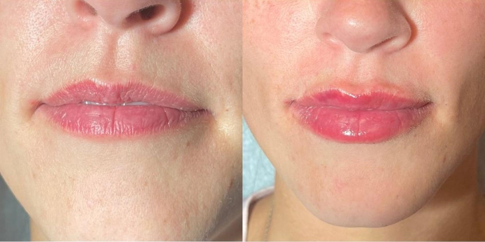 Before & After Dermal Fillers Case 21 Front View in Chico, Yuba City, & Oroville, CA