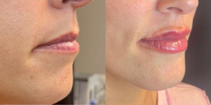 Before & After Dermal Fillers Case 22 Right Side View in Chico, Yuba City, & Oroville, CA