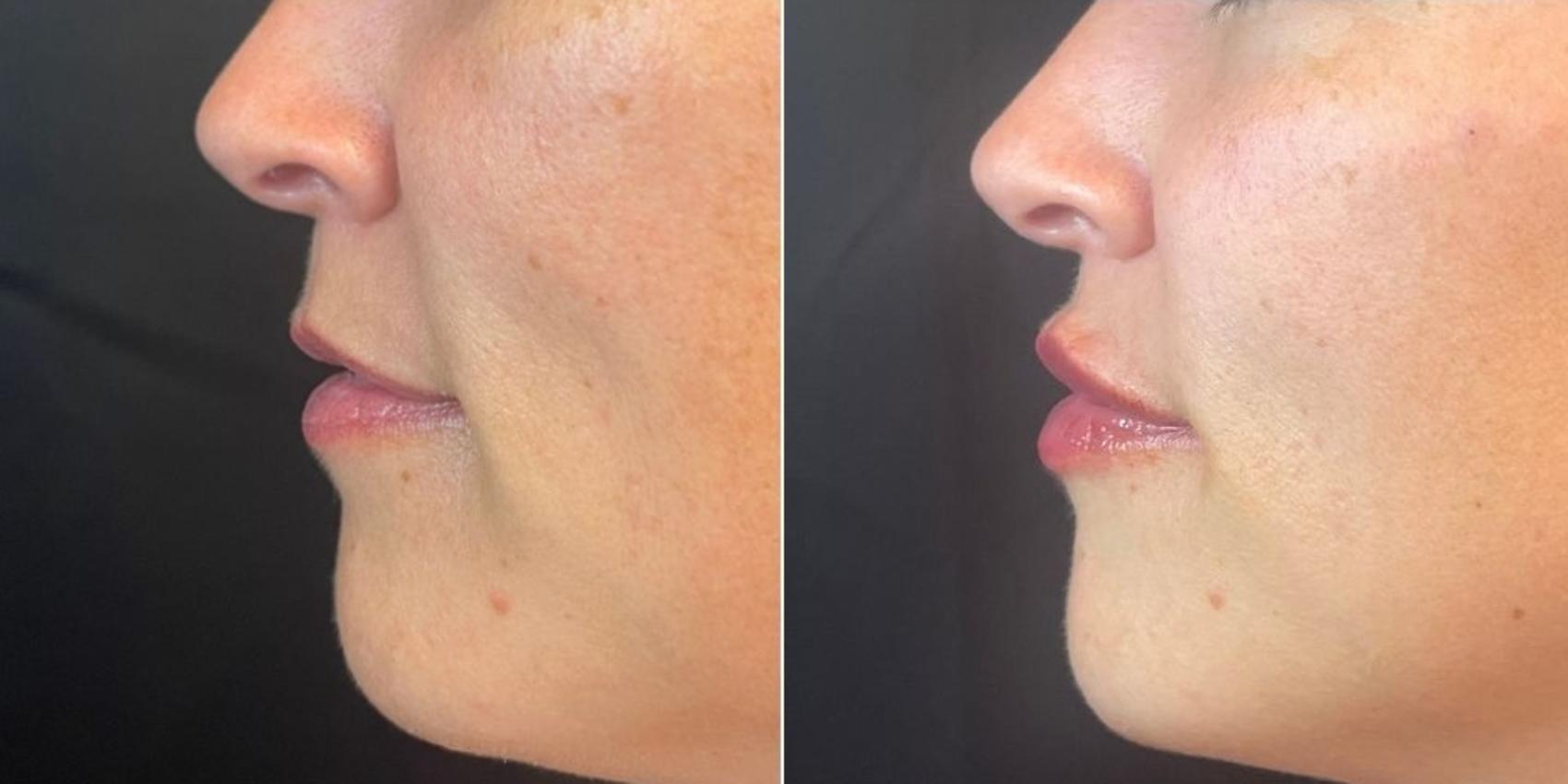 Before & After Dermal Fillers Case 24 Left Side View in Chico, Yuba City, & Oroville, CA