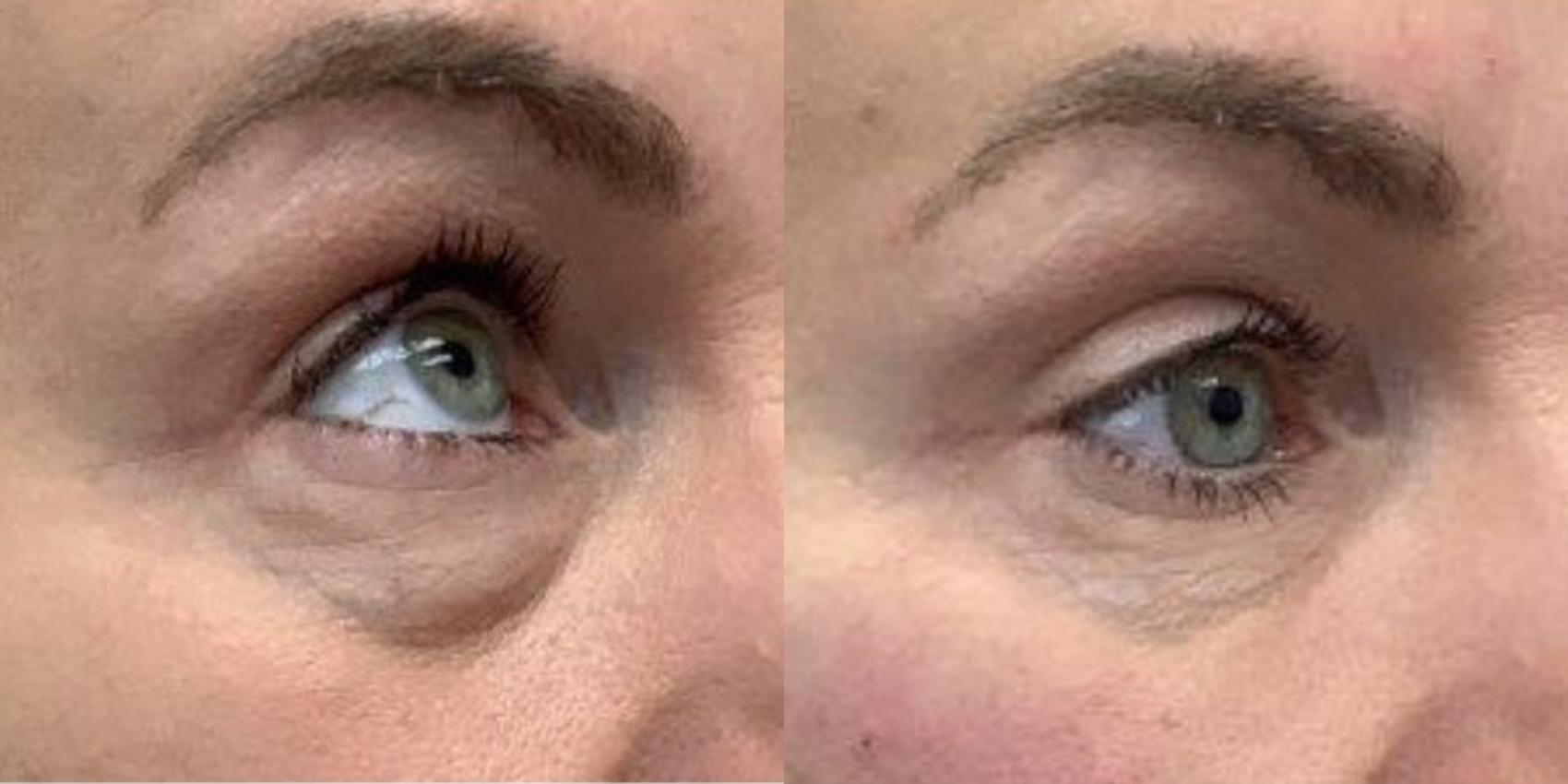 Before & After Dermal Fillers Case 25 Right Oblique View in Chico, Yuba City, & Oroville, CA
