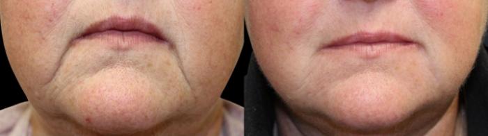 Before & After Dermal Fillers Case 26 Front View in Chico, Yuba City, & Oroville, CA