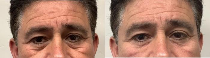 Before & After Dermal Fillers Case 27 Front View in Chico, Yuba City, & Oroville, CA