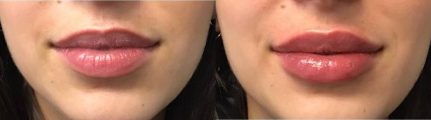Before & After Dermal Fillers Case 28 Front View in Chico, Yuba City, & Oroville, CA