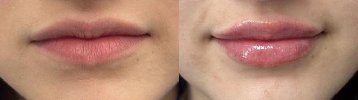 Before & After Dermal Fillers Case 29 Front View in Chico, Yuba City, & Oroville, CA