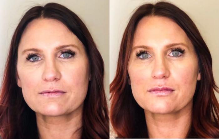 Before & After Dermal Fillers Case 30 Front View in Chico, Yuba City, & Oroville, CA