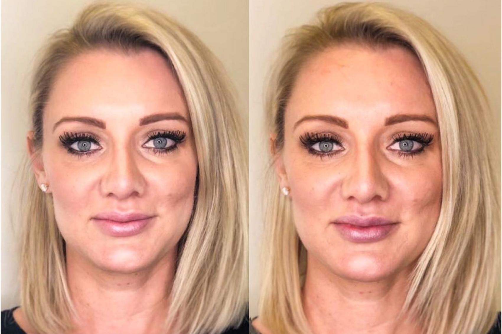 Before & After Dermal Fillers Case 31 Front View in Chico, Yuba City, & Oroville, CA