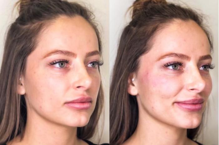 Before & After Dermal Fillers Case 32 Right Oblique View in Chico, Yuba City, & Oroville, CA
