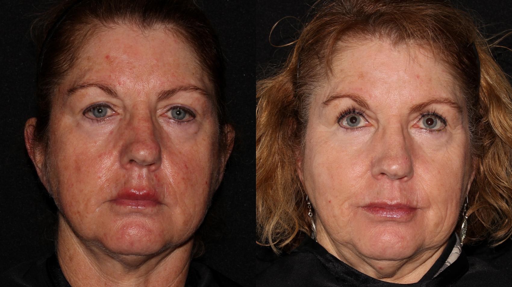 Before & After Halo® Skin Rejuvenation Case 2 Front View in Chico, Yuba City, & Oroville, CA