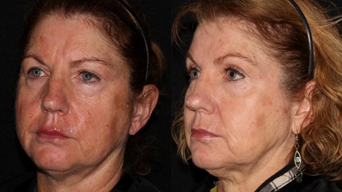 Before & After Halo® Skin Rejuvenation Case 2 Left Oblique View in Chico, Yuba City, & Oroville, CA