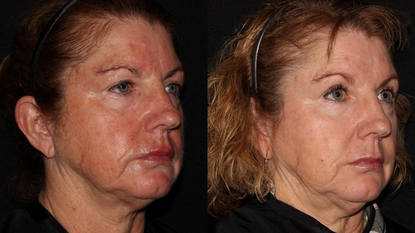 Before & After Halo® Skin Rejuvenation Case 2 Right Side View in Chico, Yuba City, & Oroville, CA