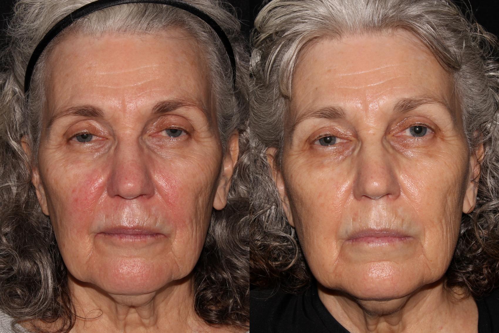Before & After Halo® Skin Rejuvenation Case 39 Front View in Chico, Yuba City, & Oroville, CA