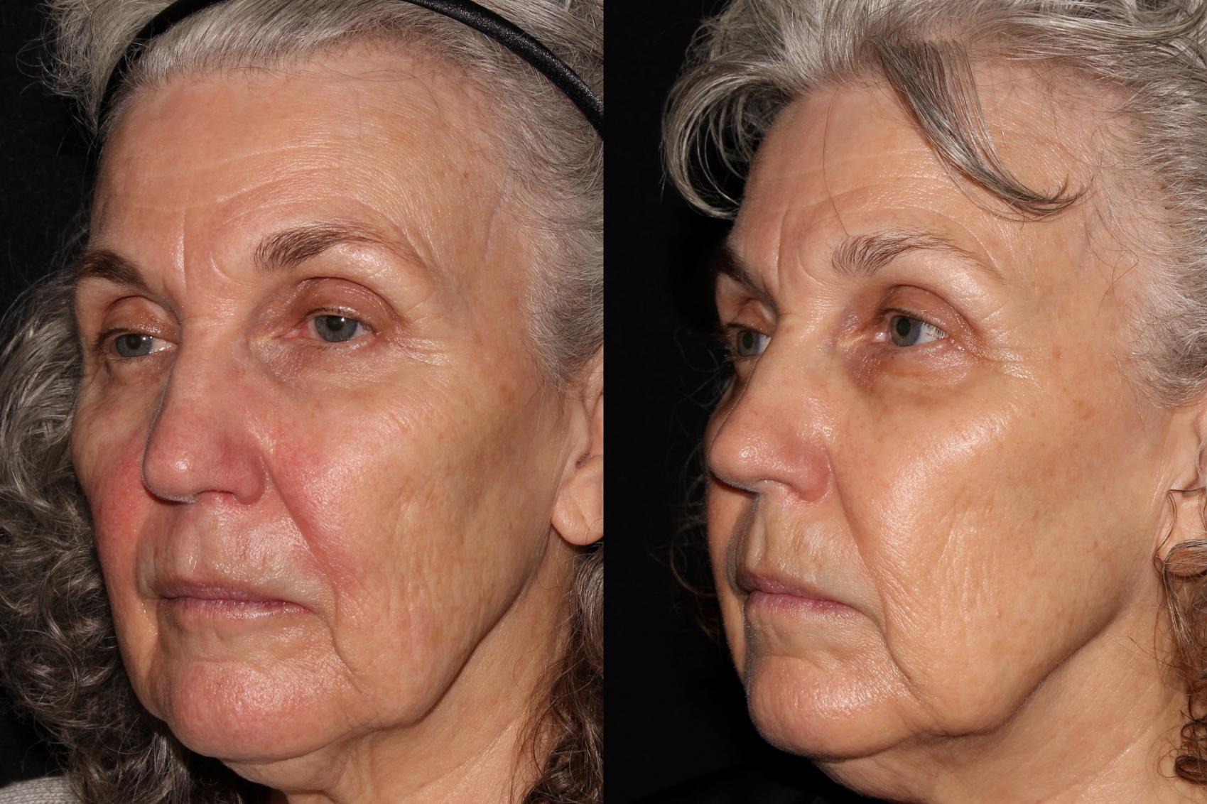 Before & After Halo® Skin Rejuvenation Case 39 Left Oblique View in Chico, Yuba City, & Oroville, CA