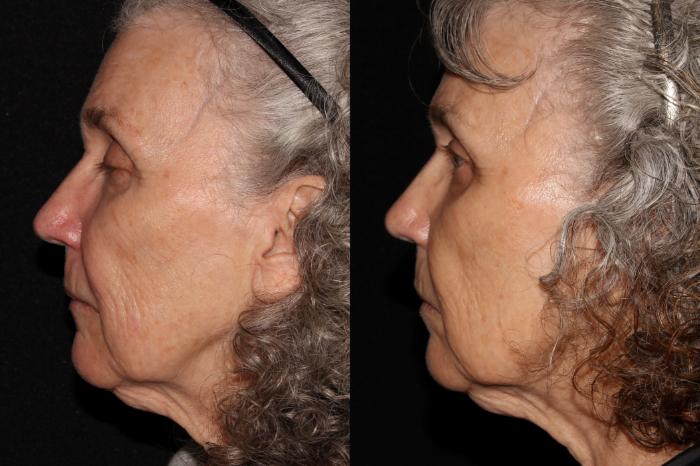 Before & After Halo® Skin Rejuvenation Case 39 Left Side View in Chico, Yuba City, & Oroville, CA