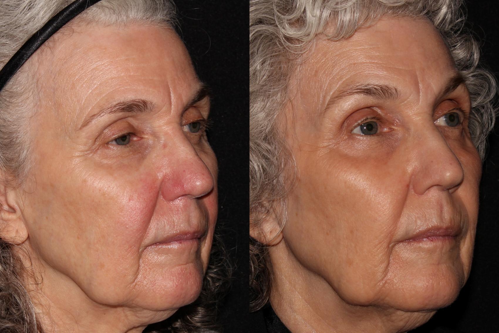 Before & After Halo® Skin Rejuvenation Case 39 Right Oblique View in Chico, Yuba City, & Oroville, CA