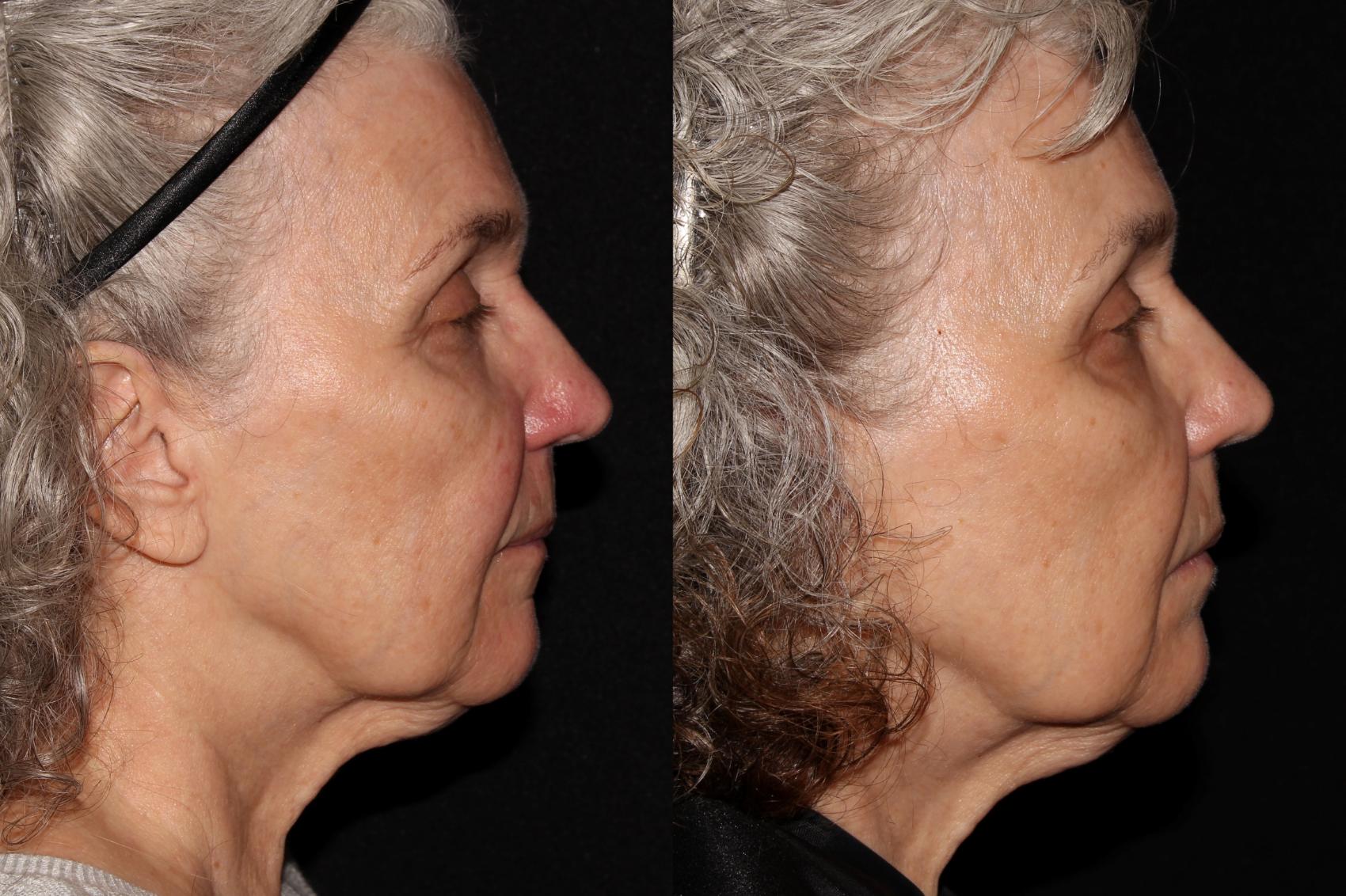 Before & After Halo® Skin Rejuvenation Case 39 Right Side View in Chico, Yuba City, & Oroville, CA